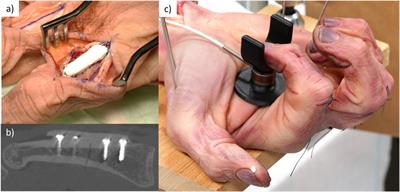 Determination of the internal loads experienced by proximal phalanx fracture fixations during rehabilitation exercises